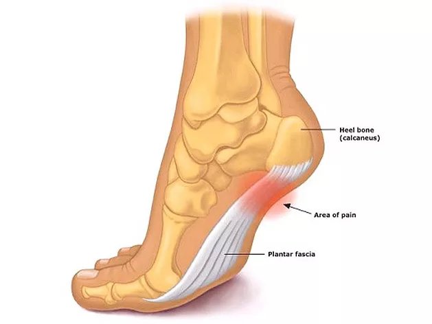 Image showing inflammed plantar fascia